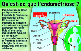 leur-combat-contre-l-endometriose-santecool