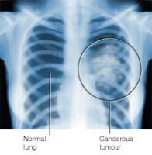survie cancer du poumon non à petites cellules