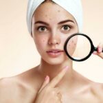 Les médecines douces contre l’acné