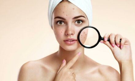 Les médecines douces contre l’acné