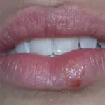 Soignez un bouton de fièvre avec les médecines douces