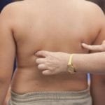 Obésité : manger moins ne fait pas perdre de graisse