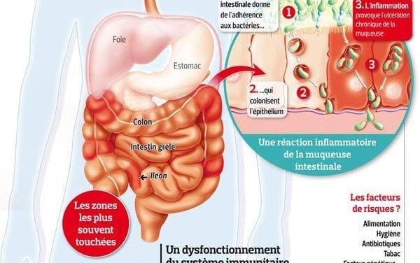 De nouveaux traitements pour la maladie de Crohn
