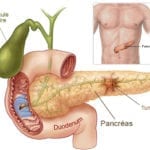 Cancer du pancréas, l’épigénétique ouvre des perspectives de traitement
