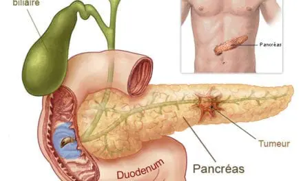 Cancer du pancréas, l’épigénétique ouvre des perspectives de traitement