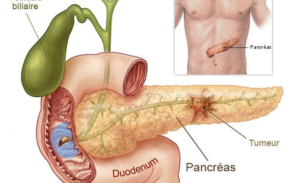 Cancer du pancréas, l’épigénétique ouvre des perspectives de traitement