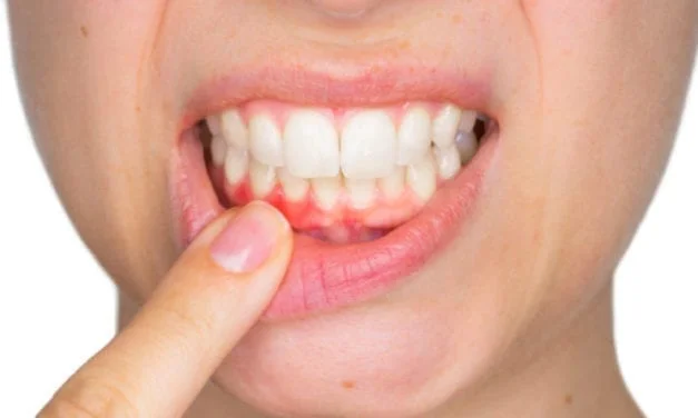 Soulager une gingivite avec les médecines douces