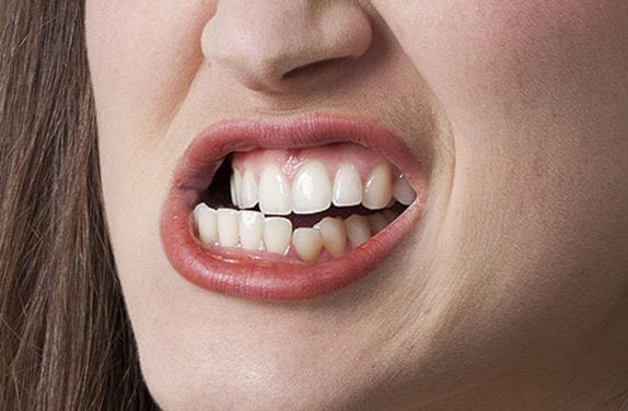 Bruxisme, desserrez les dents !