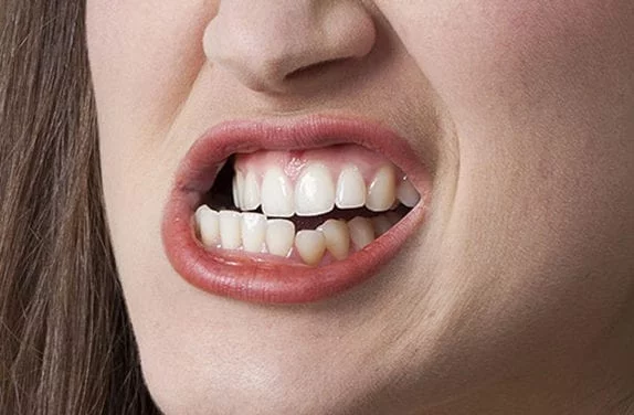 Bruxisme, desserrez les dents !