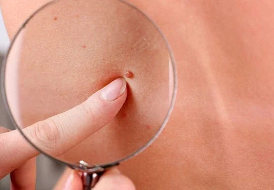 Les différents types de cancer de la peau