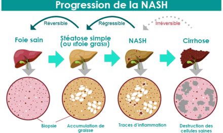 Un traitement pour la NASH ou maladie du foie gras?