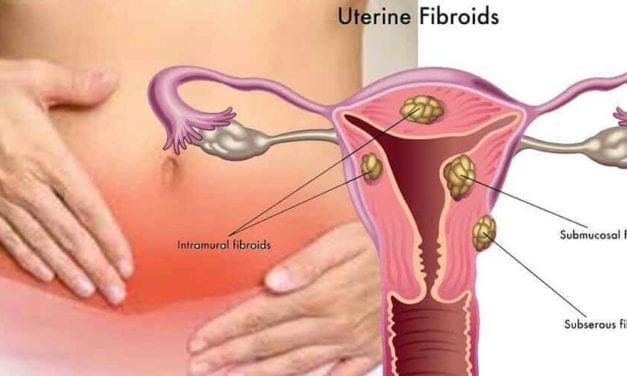 Nouveaux traitements contre le fibrome