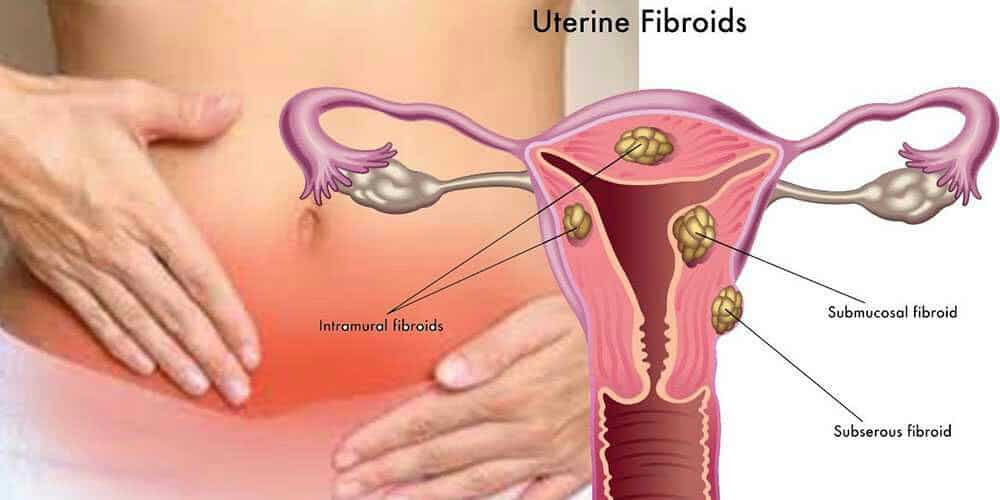 Nouveaux traitements contre le fibrome