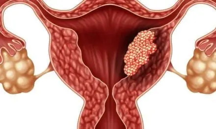 Le cancer de l’endomètre, le plus fréquent des cancers gynécologiques