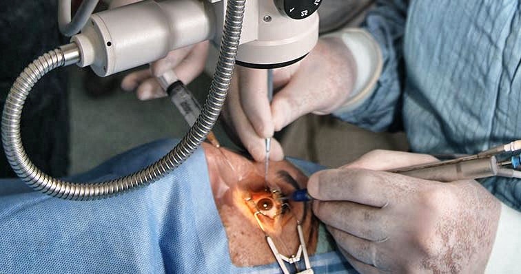 chirurgie-de-la-cataracte-lanesthesie-locale-suffit