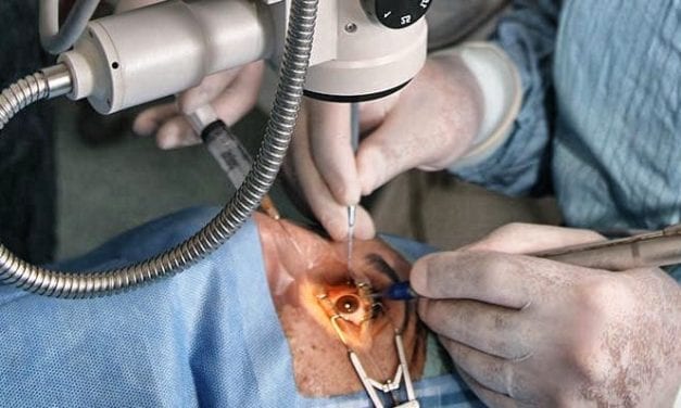 Chirurgie de la cataracte, l’anesthésie locale suffit