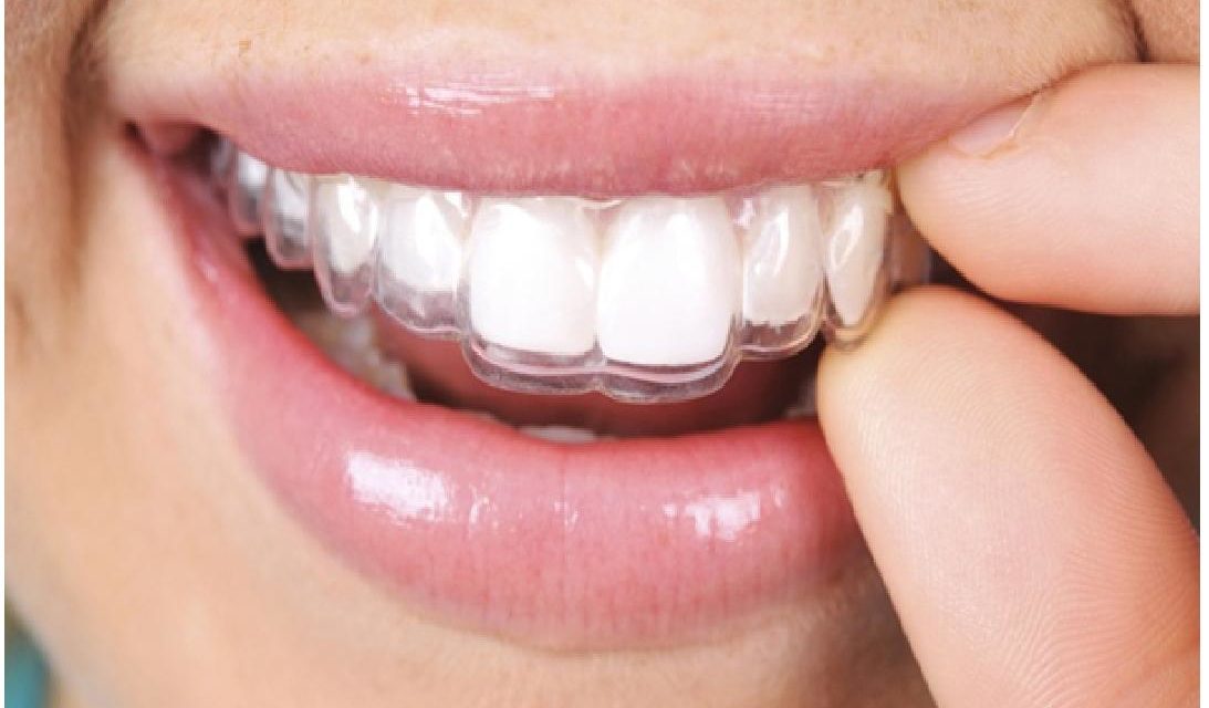 Comment se passe l’orthodontie de l’adulte?