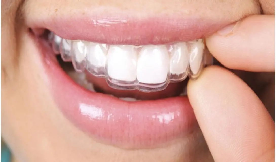 Comment se passe l’orthodontie de l’adulte?