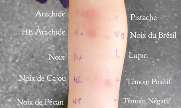 Comment diagnostiquer les allergies ?