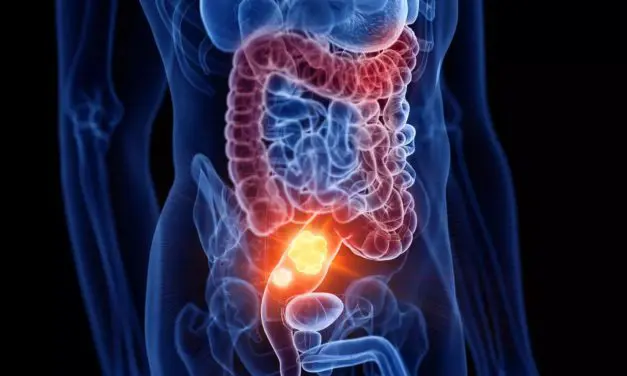 Des bithérapies pour le traitement de la rectocolite hémorragique