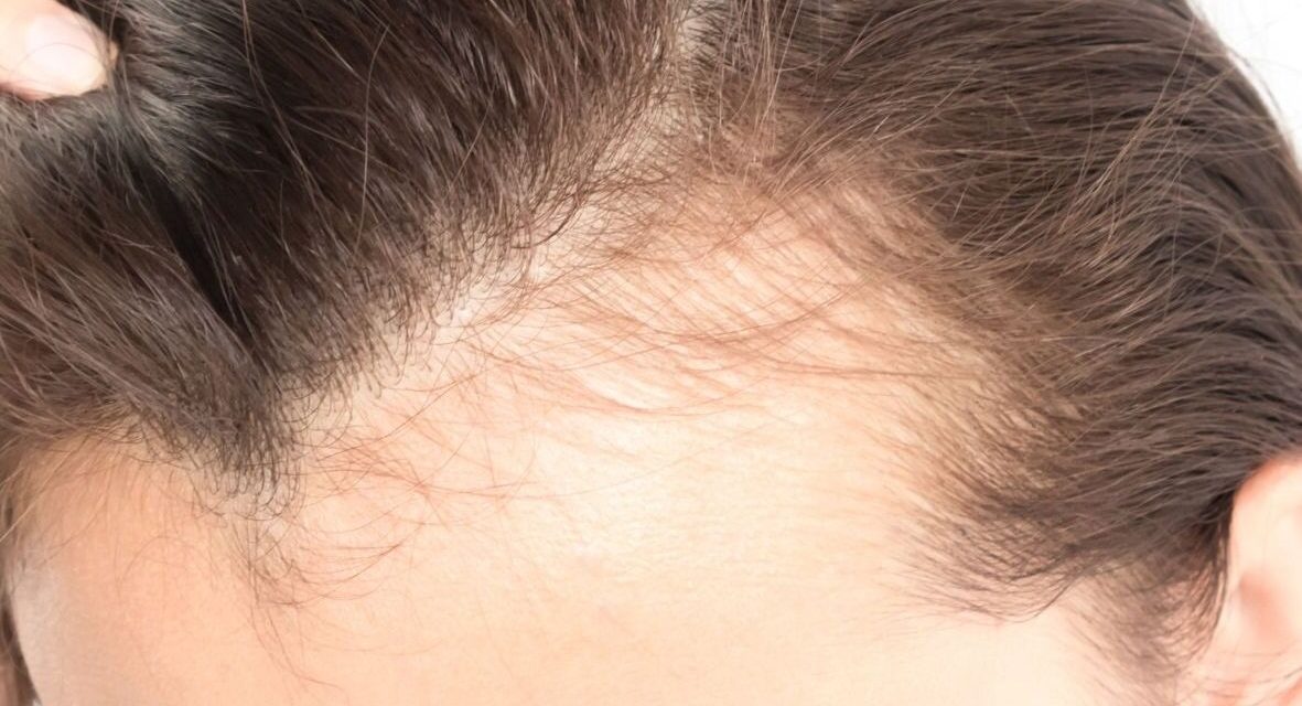 Est-ce que l’implant capillaire est la solution à la perte de cheveux ?