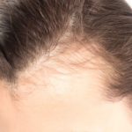 Est-ce que l’implant capillaire est la solution à la perte de cheveux ?