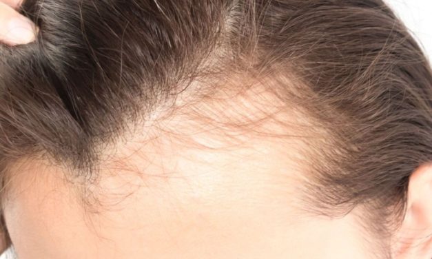 Est-ce que l’implant capillaire est la solution à la perte de cheveux ?