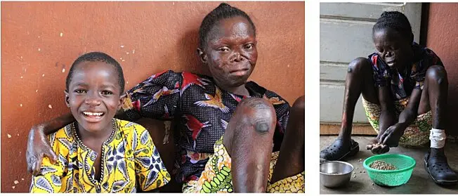 La lèpre frappe encore 1 personne toutes les 3 minutes