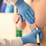 Poitrine : et si vous optiez pour la chirurgie ?