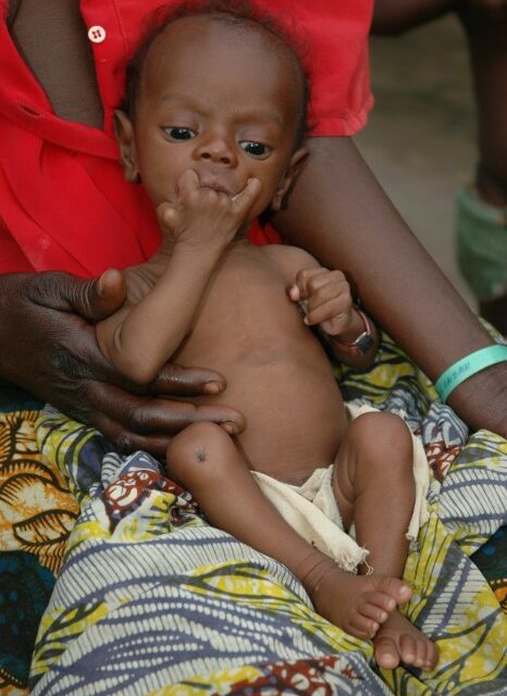 Malnutrition infantile : succès d’une nouvelle stratégie pour soigner plus d’enfants à moindre coût