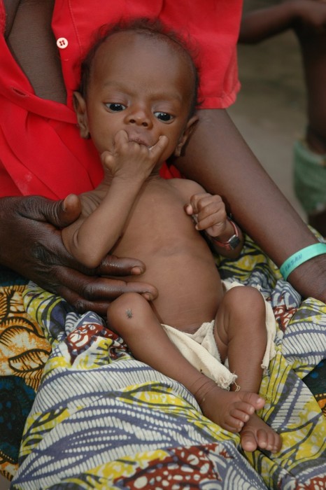 malnutrition-infantile-succes-dune-nouvelle-strategie-pour-soigner-plus-denfants-a-moindre-cout
