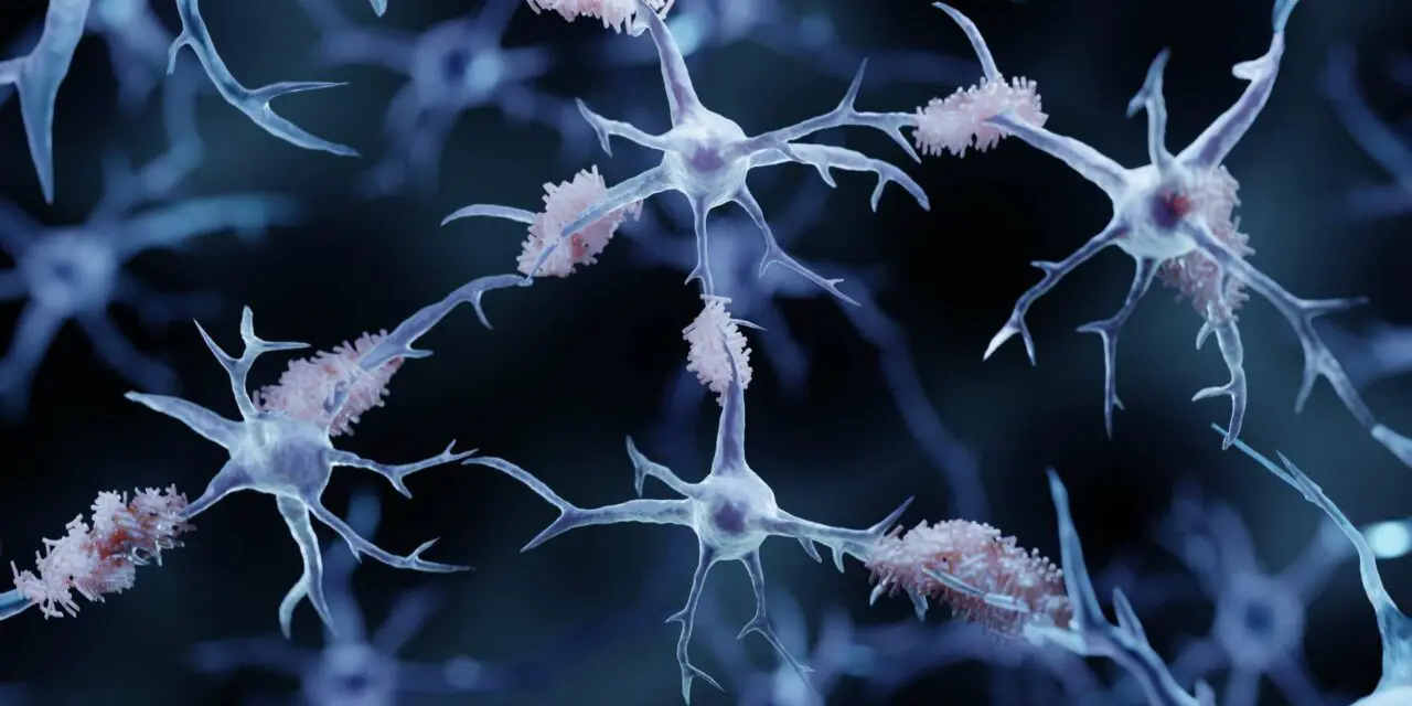 Maladie d’Alzheimer : 75 facteurs de risques génétiques identifiés