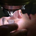 Tout savoir sur la chirurgie réfractive