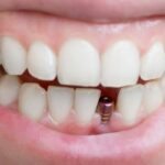 Tout savoir sur les implants dentaires