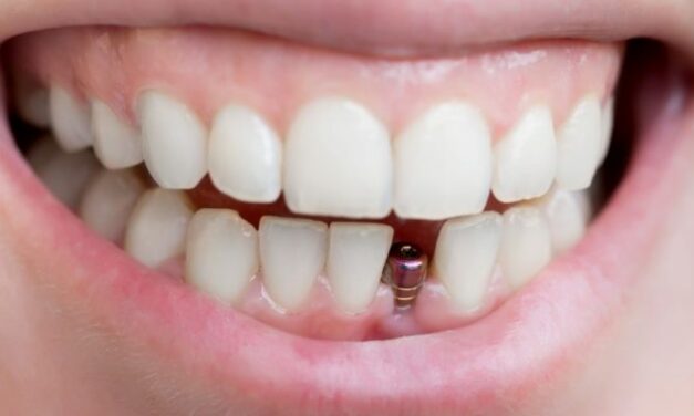 Tout savoir sur les implants dentaires