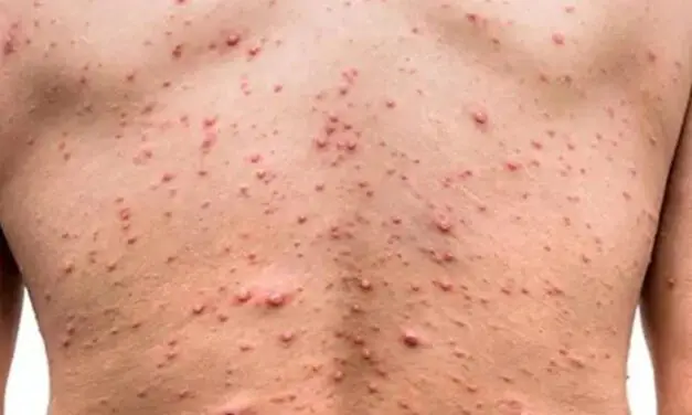 Qu’est-ce que la variole du singe ?