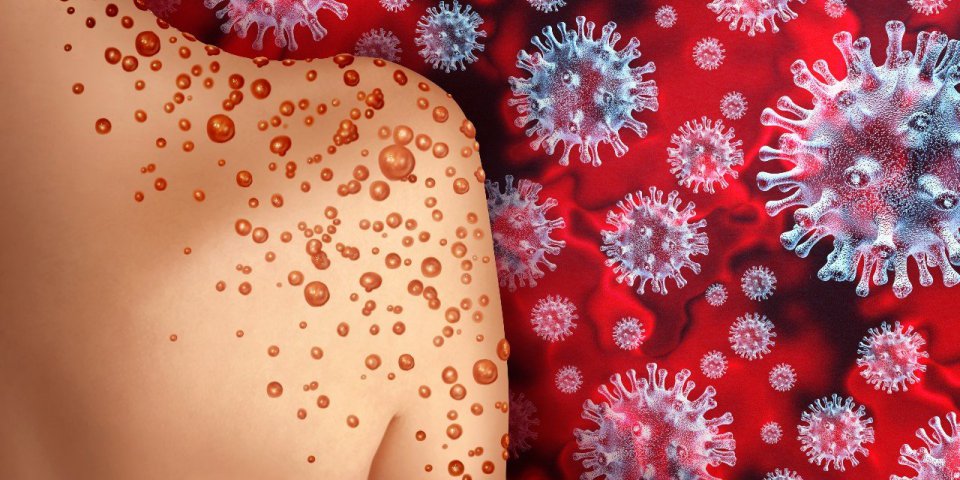 La variole du singe peut être maîtrisée par des actions rapides, rassure l’OMS