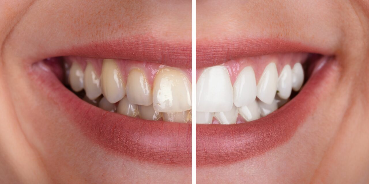 Qu’est-ce que nous disent les dents jaunes sur notre santé ?