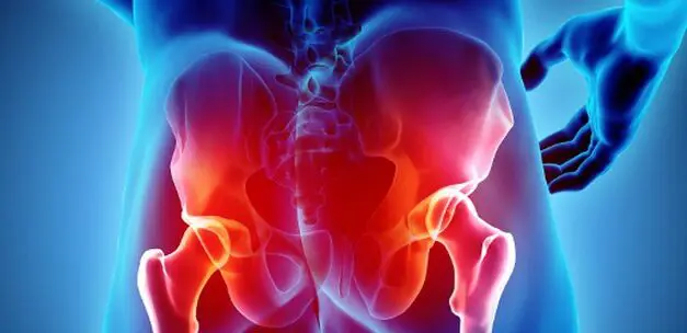 Tout savoir sur le syndrome sacro-iliaque