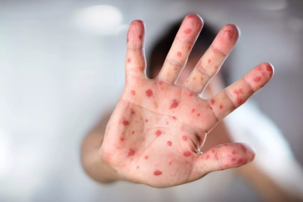 grippe-de-la-tomate-des-symptomes-du-covid-et-de-la-variole-qui-ne-touchent-que-les-enfants