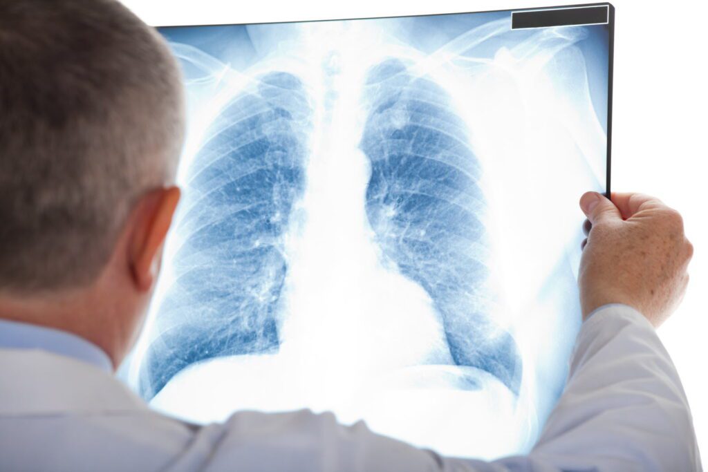 comment-diagnostiquer-precocement-le-cancer-du-poumon