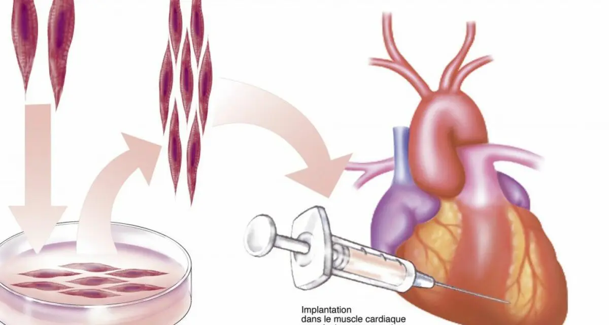 Greffe de cellules souches dans le cœur