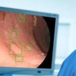 L’intelligence artificielle pour détecter les polypes colorectaux