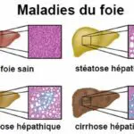 Des espoirs pour traiter la fibrose hépatique