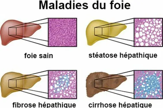 Des espoirs pour traiter la fibrose hépatique