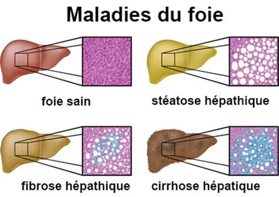 Des espoirs pour traiter la fibrose hépatique