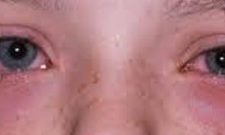 La Kératoconjonctivite vernale, une maladie oculaire méconnue