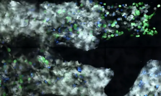 Destruction à distance des cellules cancéreuses : effet des immunothérapies dans les cancers du sang