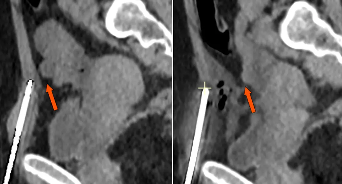 cryoablation-de-lendometriose-parietale-une-solution-revolutionnaire-pour-eliminer-les-nodules-definitivement