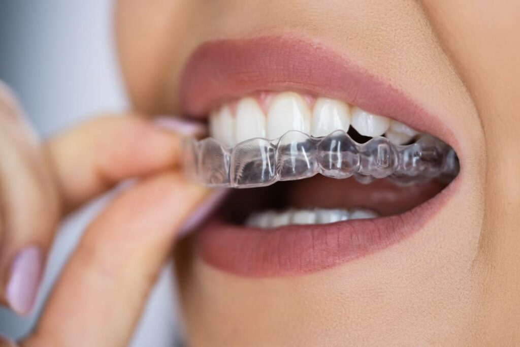 orthodontie-les-techniques-dalignement-des-dents